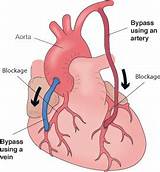 Pictures of Triple Heart Bypass Surgery Recovery