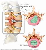 Herniated Disk L5 S1 Treatment Images