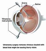 Retinal Detachment Surgery Gas Bubble
