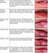 Medication To Stop Cold Sores Pictures