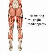 Images of Ischial Tuberosity Pain Syndrome Treatment