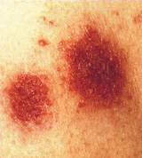 Discoid Eczema Home Remedies Pictures