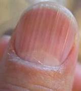 Photos of Pink Toenails Medical Condition