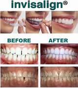 Pictures of Invisalign Insurance Providers