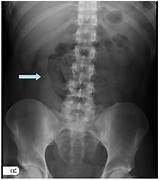 Images of Gas X For Abdominal Pain