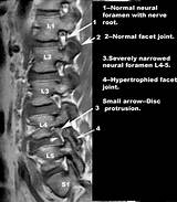 Vacuum Phenomenon Lumbar Spine Treatment Images