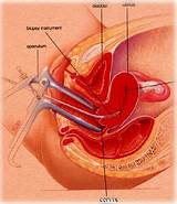 Ablation Uterus Recovery Photos