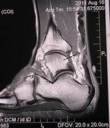 Photos of What Is The Recovery Time For A Torn Achilles Tendon
