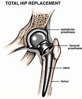 Pictures of Partial Hip Replacement Recovery Time Elderly