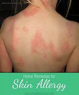 Fish Allergy Treatment Images