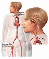 Brain Aneurysm Treatment And Recovery