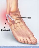 Sprained Ankle Therapy Images