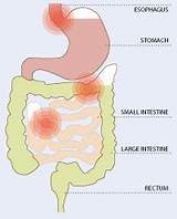 Images of What Causes Intestinal Gas Pain