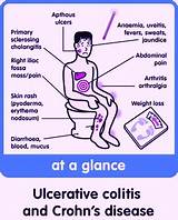 Photos of Ulcerative Colitis Joint Pain Treatment