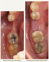 Pictures of Can Bone Graft Prevent Dry Socket