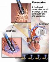 Pacemaker Recovery Restrictions Photos
