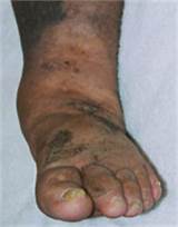 Images of Stage 3 Lymphedema Treatment