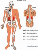 Images of Where Can Kidney Pain Be Felt