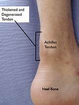 Insertional Achilles Tendonitis Surgery Recovery Time Pictures