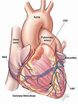 Pictures of What Can Cause Coronary Artery Disease