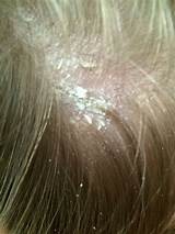 Psoriasis On Your Scalp Treatment