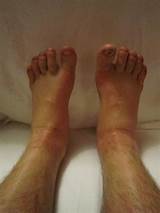 Images of Which Doctor To Consult For Swelling In Feet