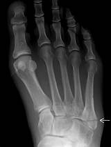 Images of Foot Fracture Surgery Recovery Time