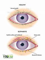 Images of Inflamed Eyelid Home Remedies