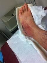 Pictures of Ankle Replacement Recovery Blog