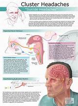 Treatment For Chronic Cluster Headaches Images