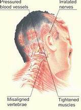Pictures of Barometric Headaches Treatment