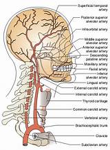 Carotid Artery Stroke Recovery Images
