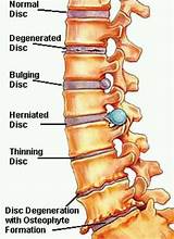 Paracentral Disc Protrusion Treatment Options Pictures