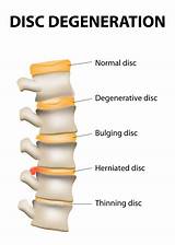Cervical Spine Disc Bulge Treatment Photos