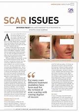 Filler Treatment For Acne Scars Images