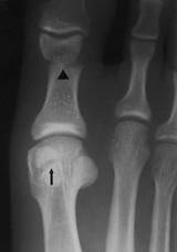 Images of Tibial Sesamoid Fracture Treatment
