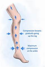 Images of Dvt Treatment Compression Stockings