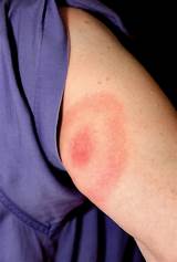 Pictures of Ringworm Symptoms In Humans Mayo Clinic