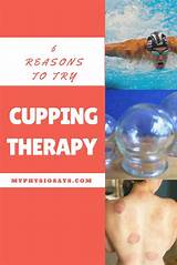 Images of Muscle Cupping Therapy