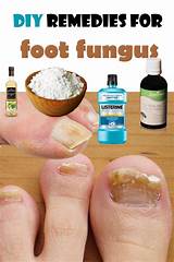 Pictures of Best Toe Fungus Medication