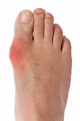 Images of What Type Of Doctor Should I See For Gout