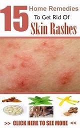 Skin Rash Treatment Home Remedies Images