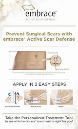 Embrace Scar Therapy