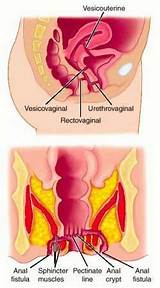 Colorectal Fistula Treatment Images