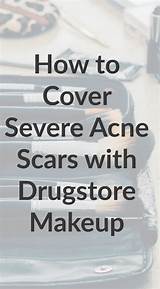 Images of What Makeup Covers Acne Scars