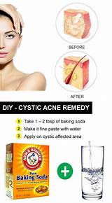 List Of Acne Treatments Photos