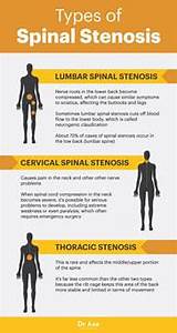 Exercises Spinal Stenosis Pictures