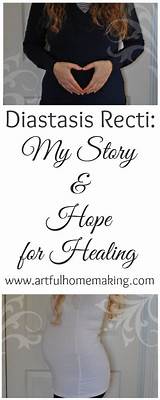 Diastasis Recti Recovery Photos