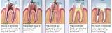 Alternative To Root Canal Treatment Images
