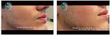 Photos of Acne Scar Treatment Nyc